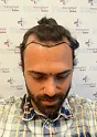 Man with hairline markings before hair transplant procedure