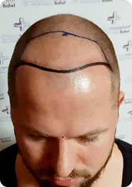 Close-up of a patient with surgical hairline markings for a hair transplant