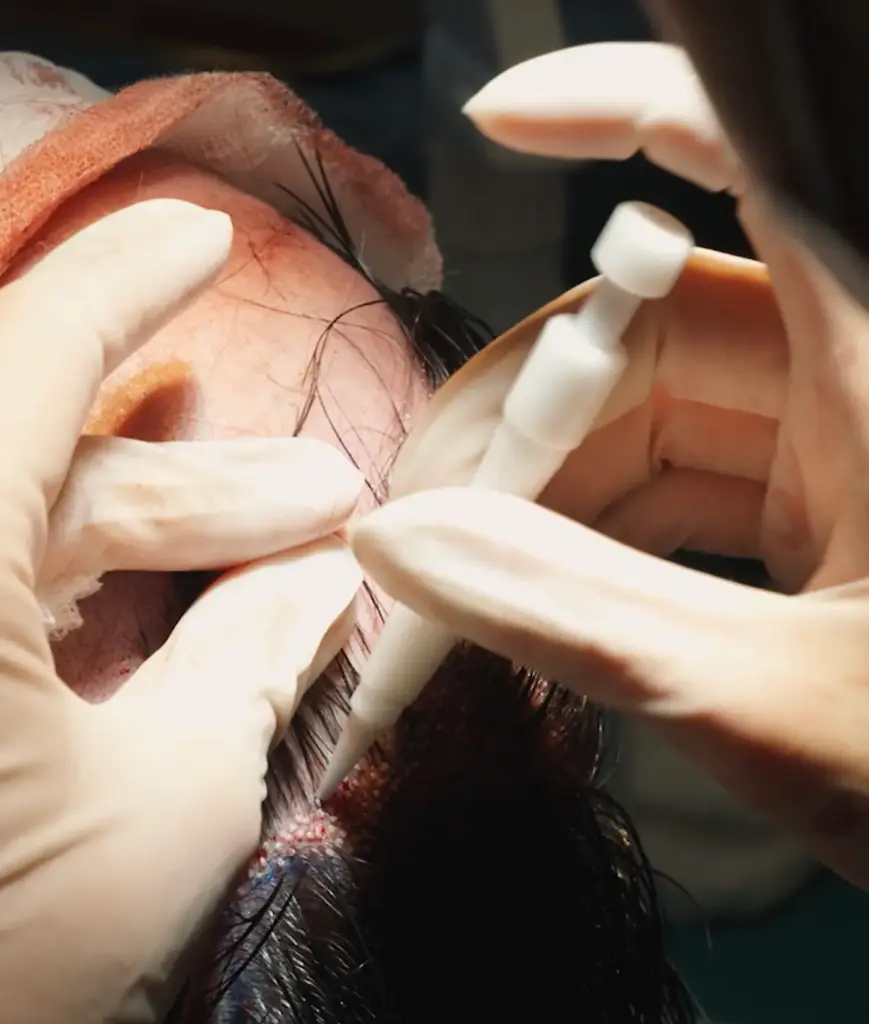 Close-up of a surgeon using a Choi implanter pen for a DHI hair transplant