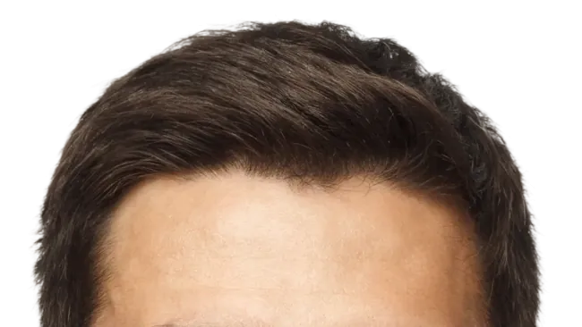 Close-up of a full, dense hairline following a hair transplant procedure